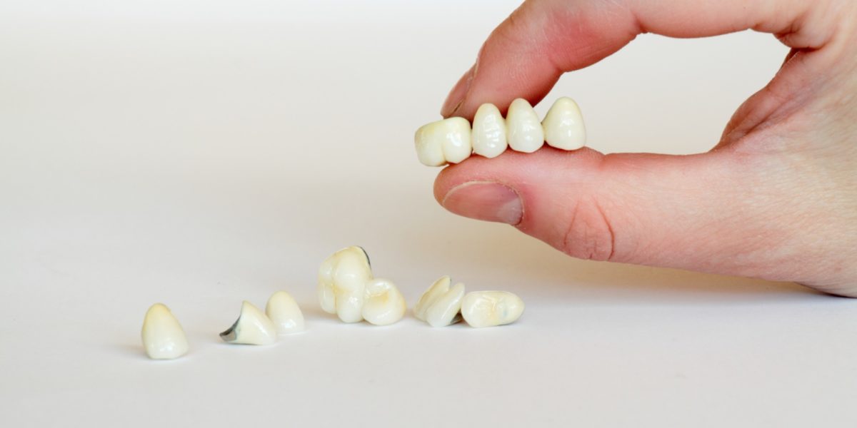 Bridge dentaire : les avantages et les inconvénients de ce type de prothèse  : Femme Actuelle Le MAG