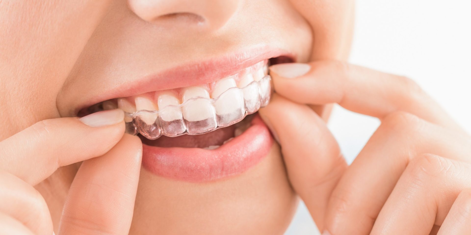 Invisalign : Orthodontie et appareil dentaire invisible - GUIDE - Dentego