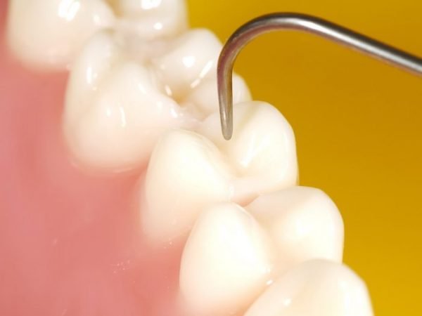 Pansement dentaire : durée, propriété et efficacité - Dr Sultan